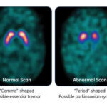 Normal vs Abnormal DaTscan: Brain scans illustrating a healthy dopamine system (left) and a dopamine-depleted system indicative of Parkinson's disease (right).